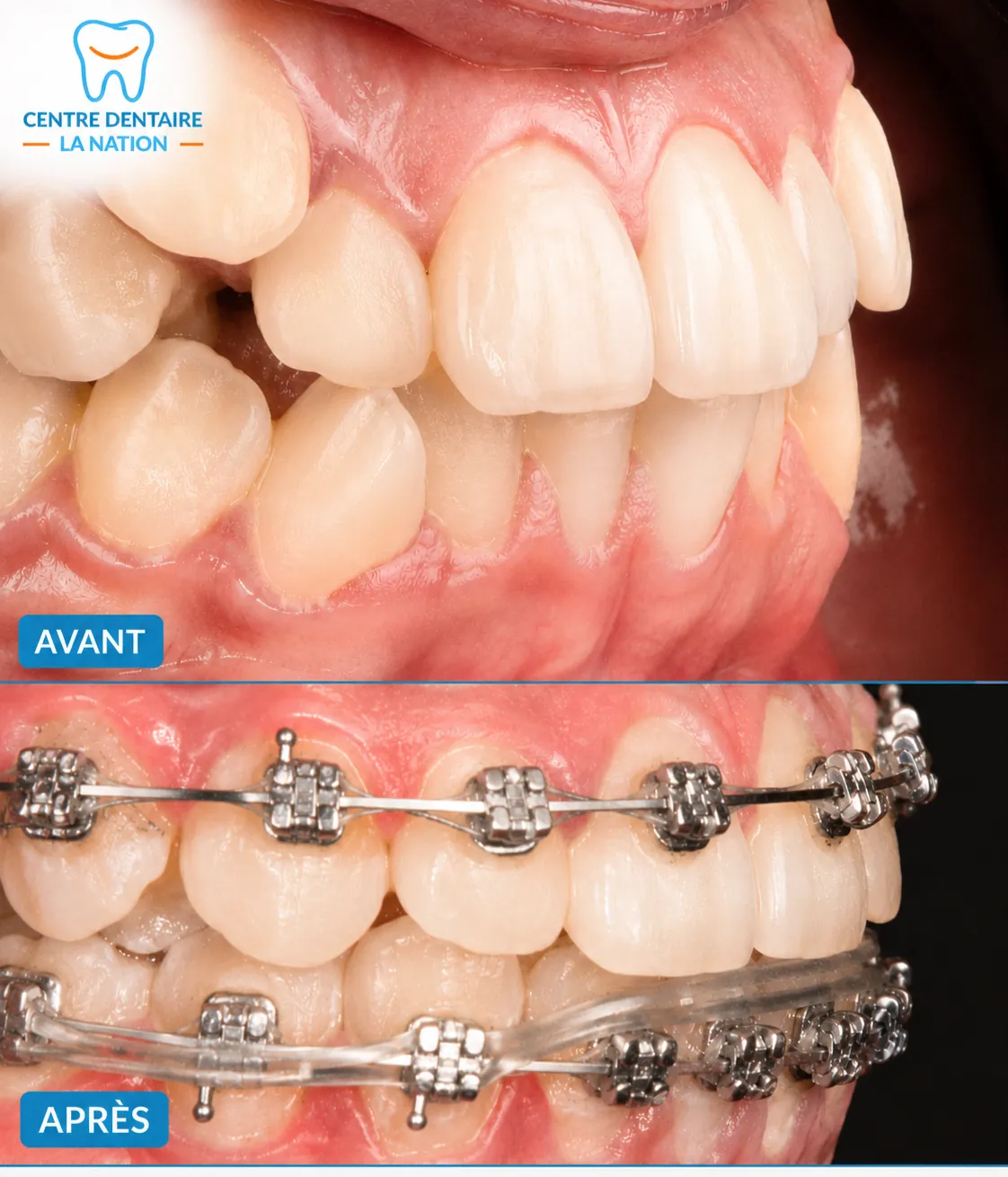 Avant et pendant un traitement orthodontique par bagues : dents chevauchées, puis alignement en cours