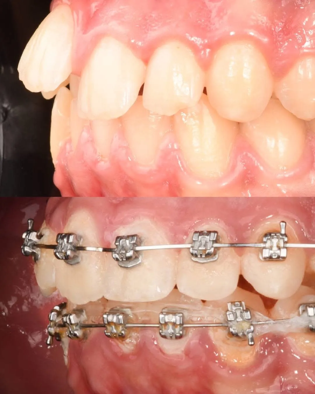 Dents du haut en avant avant traitement, puis bagues métalliques posées sur les deux arcades